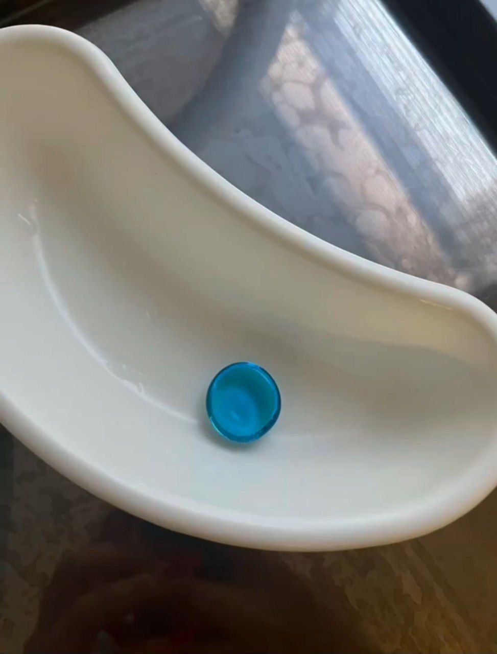 Альметьевские врачи достали из желудка ребёнка декоративный камень