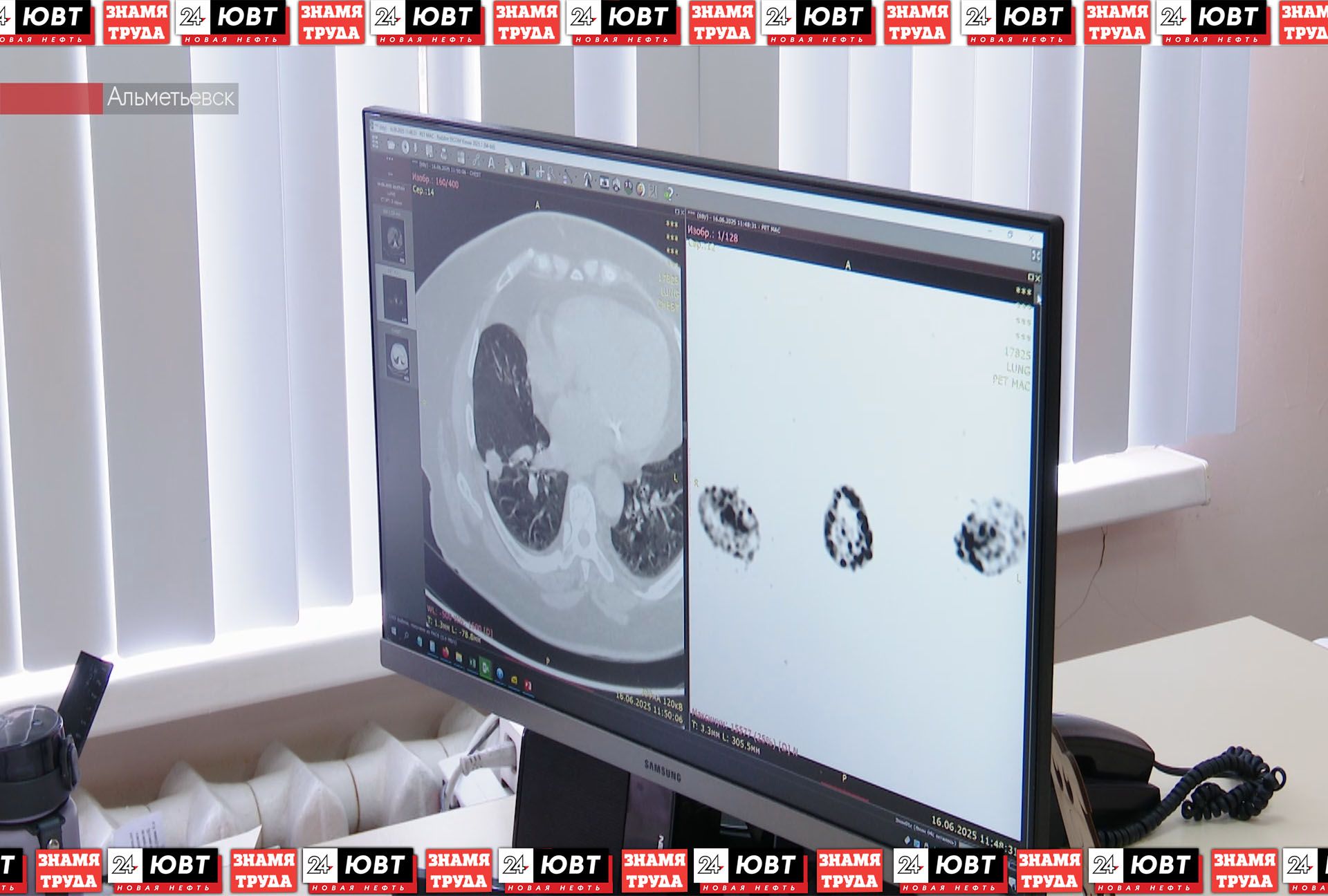 Альметьевский онколог рассказал о симптомах рака легкого