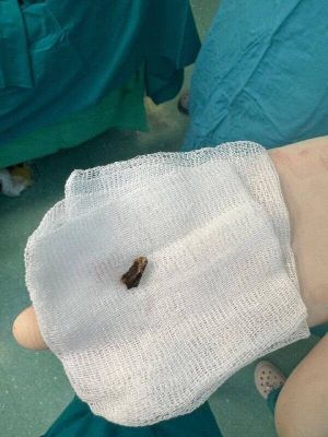 В Татарстане врачи удалили опасный осколок из печени бойца СВО